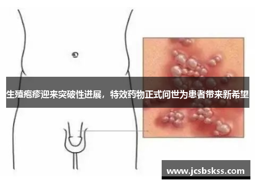 生殖疱疹迎来突破性进展，特效药物正式问世为患者带来新希望